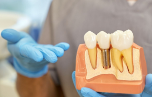 5 Everyday Goals To Discuss At A Dental Implant Consultation